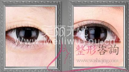 割<a href=http://www.mx185.com/listinfo-724-0.html target=_blank class=infotextkey>双眼皮</a>手术
