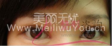 割开法<a href=http://www.mx185.com/listinfo-724-0.html target=_blank class=infotextkey>双眼皮</a>