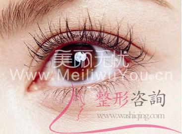 <a href=http://www.mx185.com/listinfo-724-0.html target=_blank class=infotextkey>双眼皮</a>手术