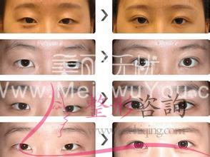 消融手术<a href=http://www.mx185.com/listinfo-724-0.html target=_blank class=infotextkey>双眼皮</a>