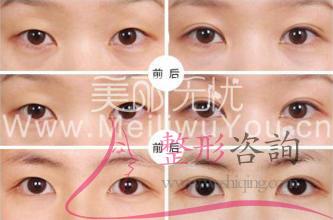 消融手术<a href=http://www.mx185.com/listinfo-724-0.html target=_blank class=infotextkey>双眼皮</a>