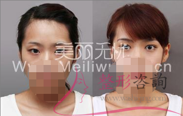 割<a href=http://www.mx185.com/listinfo-724-0.html target=_blank class=infotextkey>双眼皮</a>失败 <a href=http://www.mx185.com/listinfo-724-0.html target=_blank class=infotextkey>双眼皮</a>修复需立刻