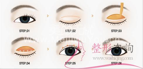 割开割<a href=http://www.mx185.com/listinfo-724-0.html target=_blank class=infotextkey>双眼皮</a>手术