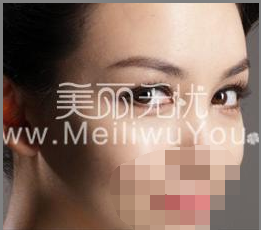 微创<a href=http://www.mx185.com/listinfo-724-0.html target=_blank class=infotextkey>双眼皮</a>手术治疗治疗