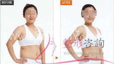 腹部<a href=http://www.mx185.com/listinfo-685-0.html target=_blank class=infotextkey>吸脂</a>术