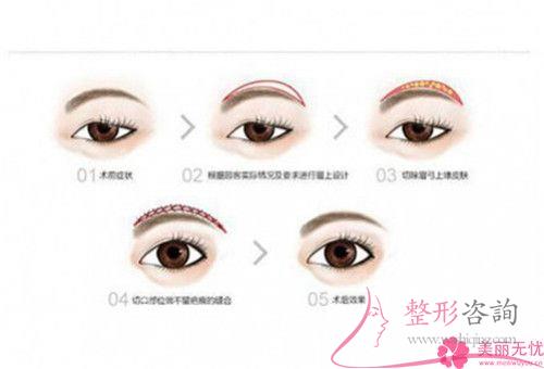 一次皮秒激光<a href=http://www.mx185.com/listinfo-658-0.html target=_blank class=infotextkey>洗眉</a>能够清洁净纹眉吗