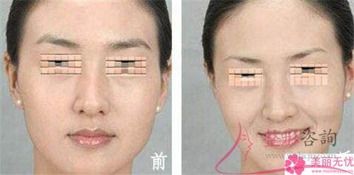 一次皮秒激光<a href=http://www.mx185.com/listinfo-658-0.html target=_blank class=infotextkey>洗眉</a>能够清洁净纹眉吗