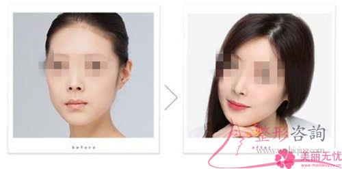 使鼻部持久立体实施硅胶能做到吗？