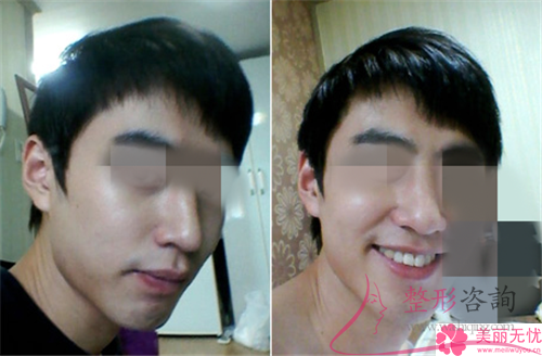 单纯假体<a href=http://www.mx185.com/listinfo-737-0.html target=_blank class=infotextkey>隆鼻</a>之后应该如何防患病毒感染