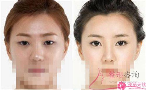 开内眼角后应该怎么护理比较好？留下线头如何是好？