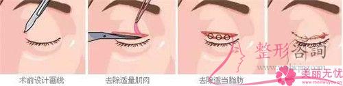 <a href=http://www.mx185.com/listinfo-711-0.html target=_blank class=infotextkey>开眼角</a>得到的效果能够持续25年吗