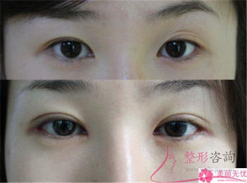 激光<a href=http://www.mx185.com/listinfo-658-0.html target=_blank class=infotextkey>洗眉</a>毛术前术后对比效果怎样？3307元能做吗
