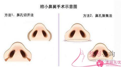 不美观的鼻翼应该怎么办