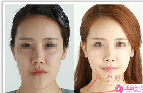 削骨<a href=http://www.mx185.com/listinfo-631-0.html target=_blank class=infotextkey>瘦脸</a>术得注意什么