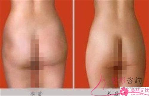 哪些人群能够接受自体<a href=http://www.mx185.com/listinfo-677-0.html target=_blank class=infotextkey>丰臀</a>