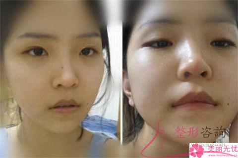 <a href=http://www.mx185.com/listinfo-754-0.html target=_blank class=infotextkey>鼻翼</a>美容整形术方式都有哪几种