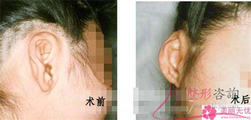 伤口沾水后不利于自体脂肪<a href=http://www.mx185.com/listinfo-694-0.html target=_blank class=infotextkey>丰耳垂</a>后的恢复吗