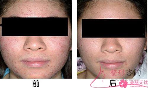 激光去痘痕大概的费用是多少