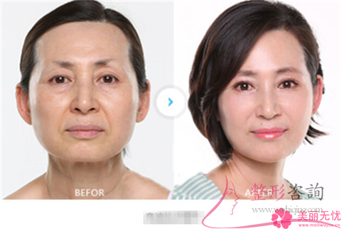 <a href=http://www.mx185.com/listinfo-611-0.html target=_blank class=infotextkey>超声刀</a>提升痛不痛啊