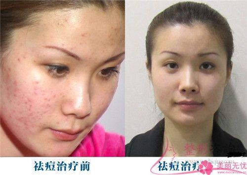 祛痘印用激光不宜人群