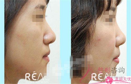短鼻延长术合适哪种人做