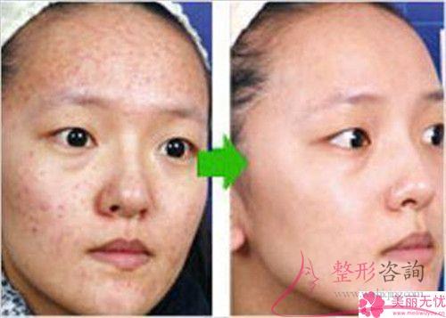 美莱激光祛痘该怎样打理？结果如何？