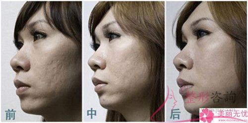 美莱激光祛痘该怎样打理？结果如何？