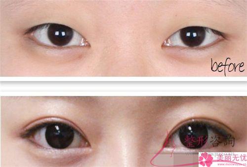 韩式<a href=http://www.mx185.com/listinfo-724-0.html target=_blank class=infotextkey>双眼皮</a>法是埋线<a href=http://www.mx185.com/listinfo-724-0.html target=_blank class=infotextkey>双眼皮</a>法吗?是可以保持多长时间