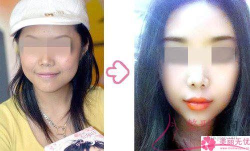 下<a href=http://www.mx185.com/listinfo-644-0.html target=_blank class=infotextkey>颌骨整形</a>术能不能让我成为瓜子脸