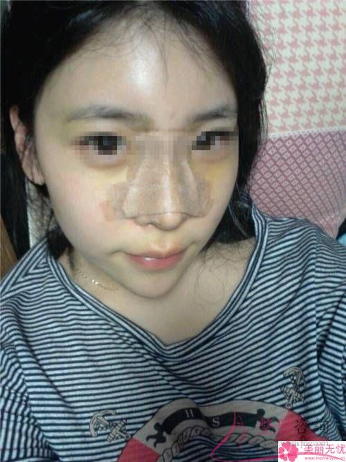 打微晶瓷<a href=http://www.mx185.com/listinfo-737-0.html target=_blank class=infotextkey>隆鼻</a>的注意事项有哪些