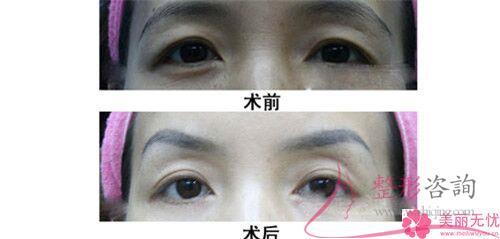 激光<a href=http://www.mx185.com/listinfo-658-0.html target=_blank class=infotextkey>洗眉</a>毛改善效果与费用各自是什么