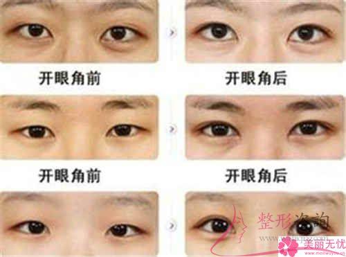 不同的6大<a href=http://www.mx185.com/listinfo-711-0.html target=_blank class=infotextkey>开眼角</a>手术的优点