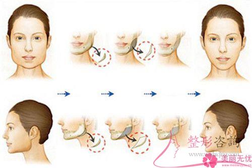 手术方法进行面部缩紧对皮肤破坏大不大