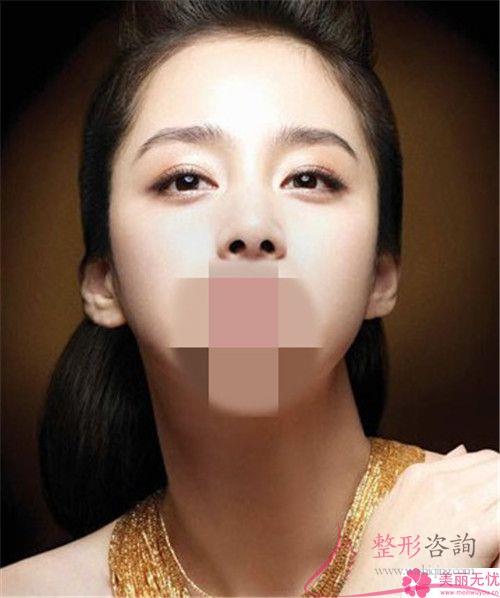 肉毒杆菌针剂得以去掉额头纹吗
