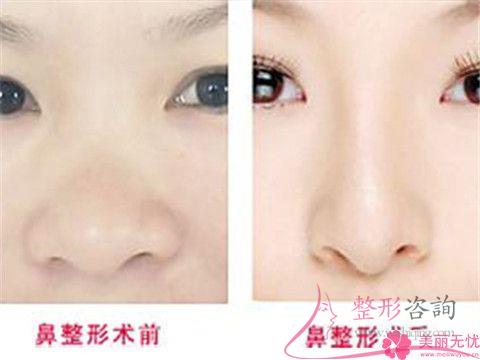 过大的<a href=http://www.mx185.com/listinfo-754-0.html target=_blank class=infotextkey>鼻翼</a>是需如何矫正