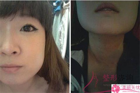 颧骨削骨术需要注意哪些事项