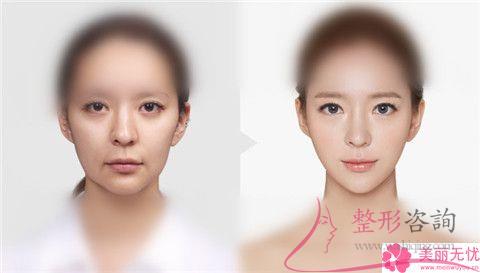 做缩小<a href=http://www.mx185.com/listinfo-754-0.html target=_blank class=infotextkey>鼻翼</a>术是什么价格