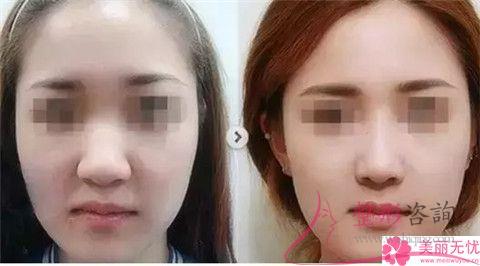 做<a href=http://www.mx185.com/listinfo-754-0.html target=_blank class=infotextkey>鼻翼</a>缩小术价格范围是多少