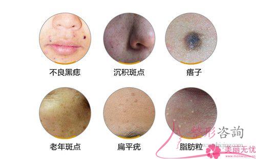 医美祛斑期间如果脸上特别红正常吗