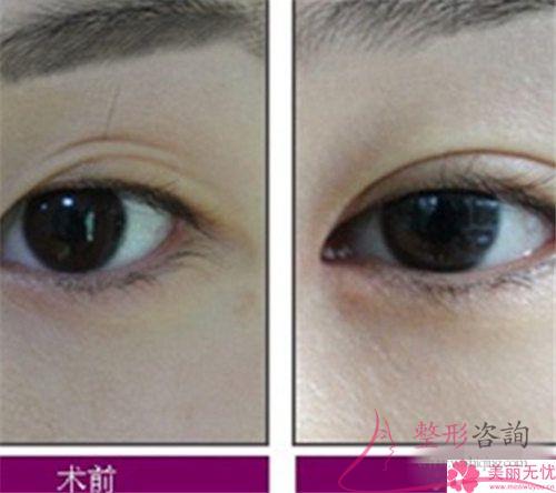 割<a href=http://www.mx185.com/listinfo-724-0.html target=_blank class=infotextkey>双眼皮</a>手术不理想情况有些什么