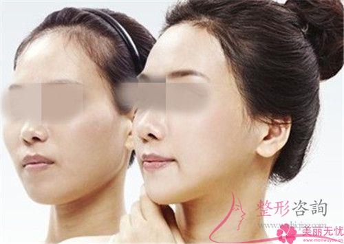 手术方法进行面部提拉对皮肤损害严不严重
