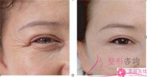 毛孔粗能实行彩光<a href=http://www.mx185.com/listinfo-770-0.html target=_blank class=infotextkey>嫩肤</a>吗