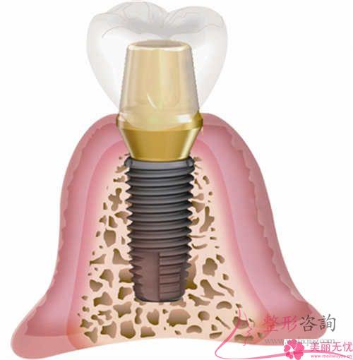 种植牙是啥与普遍价格