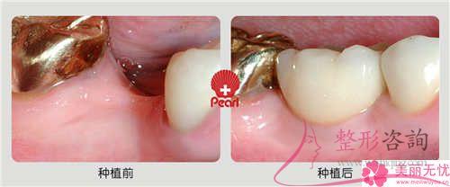 种植牙是啥与普遍价格