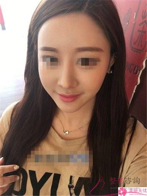空鼻手术治疗效果怎么