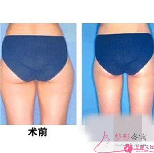 自体组织<a href=http://www.mx185.com/listinfo-677-0.html target=_blank class=infotextkey>丰臀</a>的四大长处
