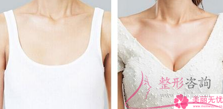 雪蓝贝假体<a href=http://www.mx185.com/listinfo-618-0.html target=_blank class=infotextkey>隆胸</a>需要好多钱？效果到底好不好？