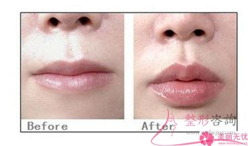 做唇珠成形手术一般使用次数最多的是哪种材料