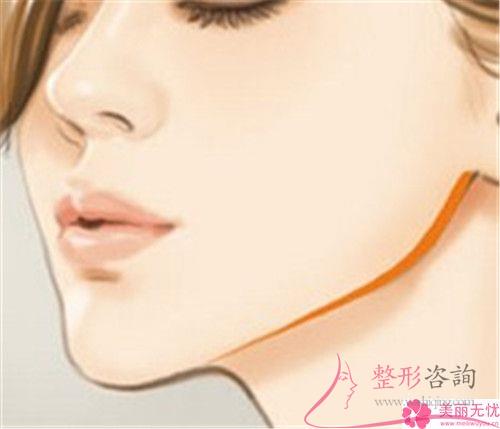 面部深层皱纹打伊维兰能否快速去除