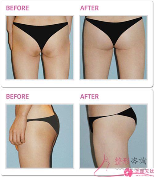 哪些女人可以做自体组织<a href=http://www.mx185.com/listinfo-677-0.html target=_blank class=infotextkey>丰臀</a>术